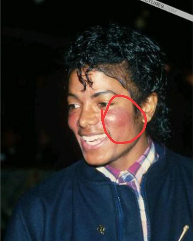 迈克杰克逊是黑人怎么变白了图8